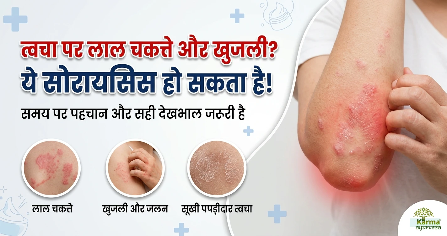 त्वचा-पर-लाल-चकत्ते-और-खुजली-ये-सोरायसिस-हो-सकता-है